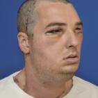 أمريكي يخضع لعملية زرع وجه جديد بعد 30 عملية فاشلة