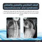 خاص| بالفيديو: أسباب تشوهات العمود الفقري وطرق الوقاية والعلاج