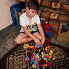 قصة مصورة| أحمد.. إصابةٌ كان يمكن علاجها فانتهت ببتر ساقه