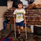 قصة مصورة| أحمد.. إصابةٌ كان يمكن علاجها فانتهت ببتر ساقه
