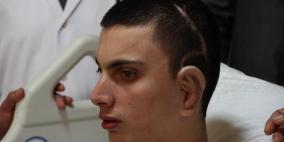 لاول مرة بالعالم.. أطباء ينجحون بزراعة أذن مستخلصة من غضروف حي