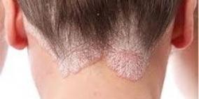 عسل النحل ومشتقاته علاج لمرض الصدفية