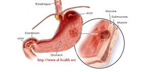 إهمال قرحة المعدة يصيبها بالسرطان