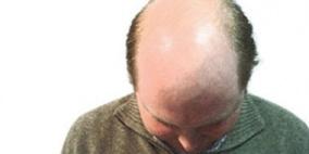 كيف يكافح شاب العشرين الصلع الوراثى وتساقط الشعر؟