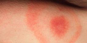 دراسة: تناول فيتامين "د" يحميك من الحساسية المؤدية للتورم