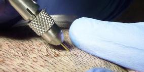 جديد عالم التجميل.. زراعة شعر اللحية