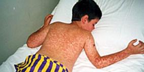 الأيدى الملوثة قد تؤدي للإصابة بالحصبة