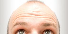 دواء للمفاصل يساعد بمداواة الثعلبة والصلع