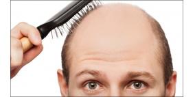 اختبار ناجح لأقراص ضد الصلع الناتج عن الثعلبة