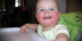 المدن الكبيرة تسبب الحساسية