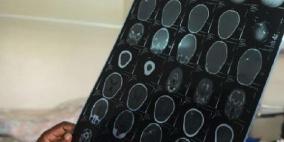 زلات الذاكرة مرتبطة بالجلطة بين المتعلمين