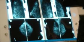 دراسة: عقار جديد قد "يطيل عمر" نصف عدد السيدات المصابات بسرطان الثدي