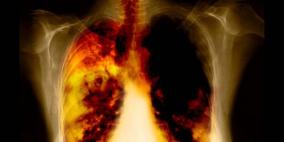 فحص الرئة الدوري ضروري للمدخنين الحاليين والسابقين