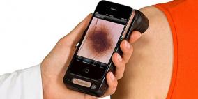 الهاتف الذكي لتشخيص سرطان الجلد