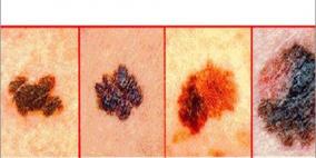 أشعة الشمس.. بين فيتامين "دي" وسرطان الجلد