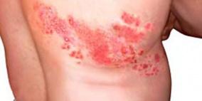 فيروس العنقز أهم مسببات الإصابة بالحزام الناري