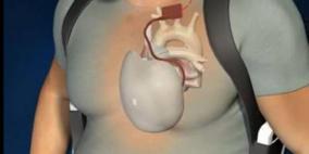 وفاة أول مريض زرع له قلب صناعي بفرنسا