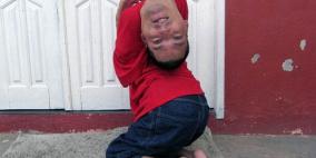 بالصور: بـ"رأس مقلوب" يرفض الإعاقة ويصبح محاسبًا ومحاضرا