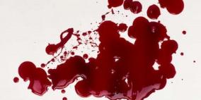 الأمراض المزمنة وخلل الأوعية الدموية يسببان بصق الدم من الفم