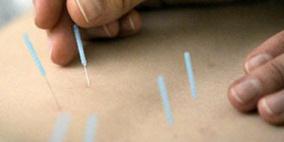 الوخز بالإبر أحدث العلاجات الطبيعية الآمنة للقضاء على حساسية الربيع