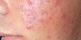 إفرازات المواد الدهنية تسبب الإصابة بـ"حب الشباب"