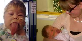 طفلة بريطانية لا يتوقف لسانها عن النمو