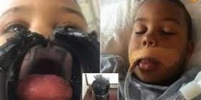طفل يعلق لسانه بقارورة مياه.. فيمضي 4 أيام بالعناية المركزة