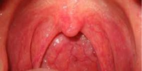 أسباب التهاب الحلق