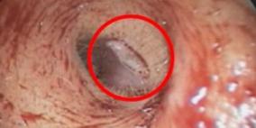 اكتشاف يرقات ذبابة فاكهة في أذن امرأة تايوانية