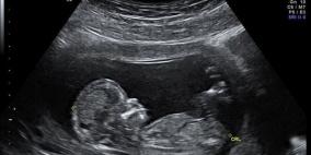 امرأة ثمانينية حاملٌ بجنين عمره 44 عاماً!