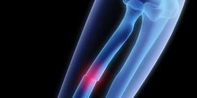 ابتكار هلام "ذكي" لتجبير كسور العظام (فيديو)