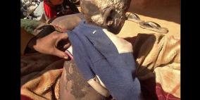 مرض نادر كاد يحول صاحبه إلى حجر!