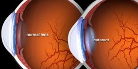 اكتشاف طريقة جديدة لعلاج إعتام عدسة العين