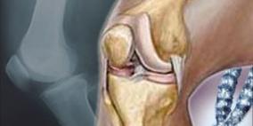 جيل طبى ذكى يعمل على سرعة توصيل العقار إلى المفاصل المتيبسة