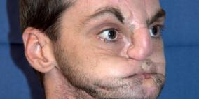 أمريكي يخضع لعملية زرع وجه جديد بعد 30 عملية فاشلة