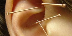 أطباء أمريكيون يبحثون فوائد الوخز بالإبر الصينية
