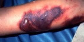 حمى الضنك أودت بحياة 573 شخصا فى البرازيل