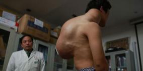 الصين...استئصال ورم وزنه 10 كيلوغرامات من ظهر شاب