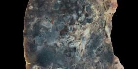 32 ألف طفل سنويا يصابون بالسل المقاوم