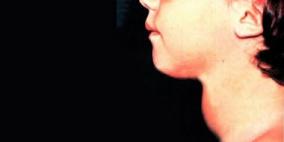 خلل المناعة سبب نشاط الغدة الدرقية