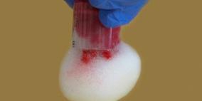 مادة جديدة لوقف النزيف مستخرجة من قشور القريدس