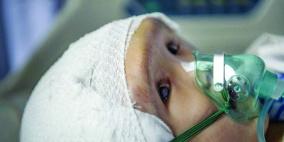 أول جمجمة بتقنية الطباعة ثلاثية الأبعاد