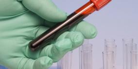 اكتشاف فيروس نقص المناعة في دم طفلة سبق علاجها من المرض