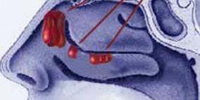 "لحميات الأنف" الأكثر شيوعًا فى أمراض الجيوب الأنفية