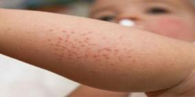 طلع الأعشاب يهيج الأكزيما