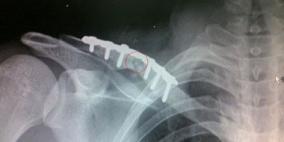 تقنية جديدة فى علاج الكسور العظمية تجنبك استخراج المسامير والشرائح