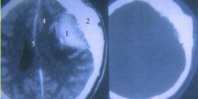 إزالة ورم تسبب لطفلة بوليفية بنوبات ضحك شبه مستمرة