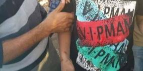 إصابة 3 أطفال بجروح في انفجار قنبلة شمال القدس