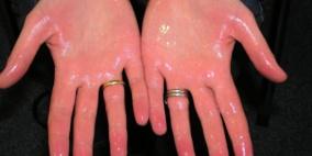 الجراحة أفضل الطرق للتخلص من مشكلة فرط التعرق