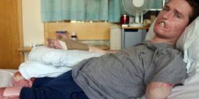 بريطاني يفقد أطرافه بسبب البرد